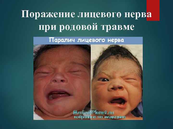 Поражение лицевого нерва  при родовой травме 