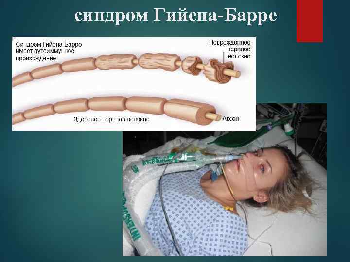 синдром Гийена-Барре 