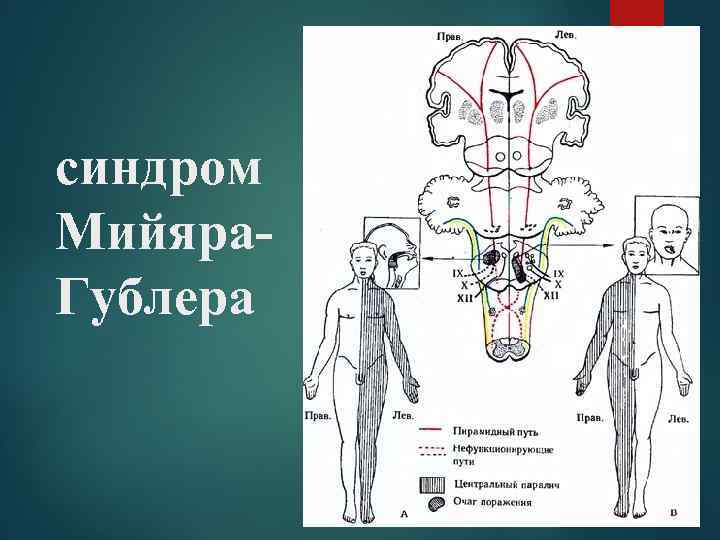 синдром Мийяра- Гублера 
