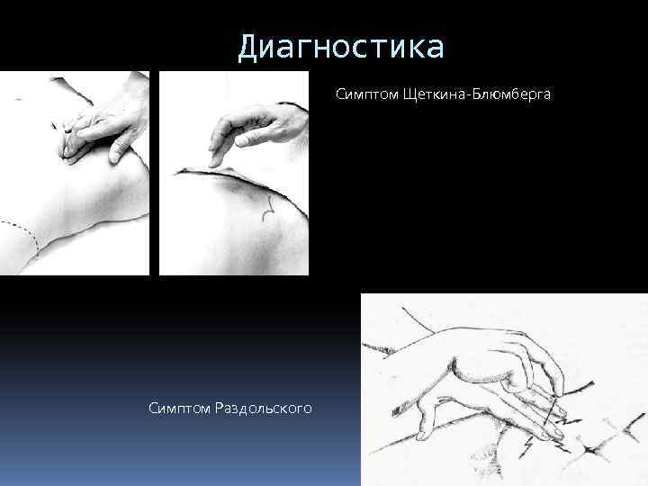    Диагностика    Симптом Щеткина-Блюмберга Симптом Раздольского 