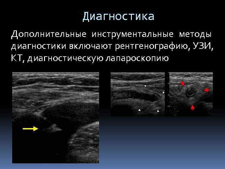    Диагностика Дополнительные инструментальные методы диагностики включают рентгенографию, УЗИ,  КТ, диагностическую