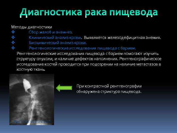 Методы диагностики v  Сбор жалоб и анамнез. v  Клинический анализ крови. Выявляется