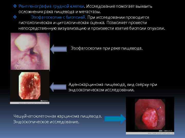 v Рентгенография грудной клетки. Исследование помогает выявить  осложнения рака пищевода и метастазы. v