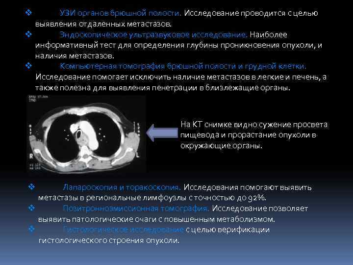 v  УЗИ органов брюшной полости. Исследование проводится с целью  выявления отдаленных метастазов.