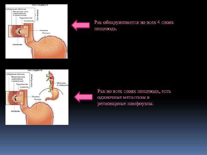 Рак обнаруживается во всех 4 слоях пищевода.  Рак во всех слоях пищевода, есть