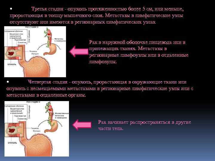  •   Третья стадия - опухоль протяженностью более 5 см, или меньше,