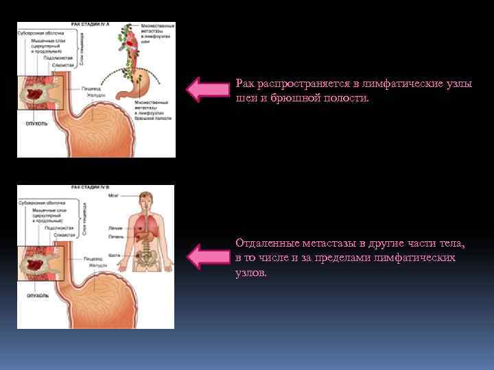 Рак распространяется в лимфатические узлы шеи и брюшной полости. Отдаленные метастазы в другие части
