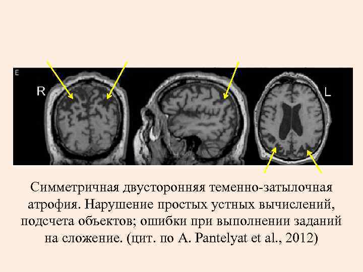  Симметричная двусторонняя теменно-затылочная атрофия. Нарушение простых устных вычислений, подсчета объектов; ошибки при выполнении