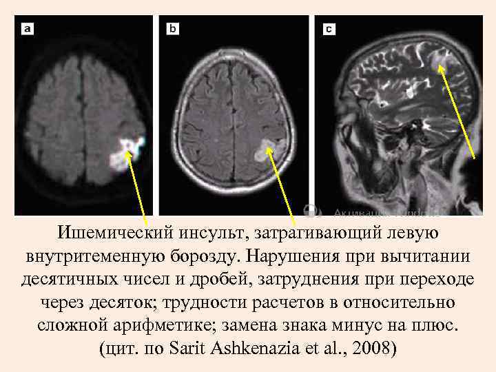   Ишемический инсульт, затрагивающий левую внутритеменную борозду. Нарушения при вычитании десятичных чисел и