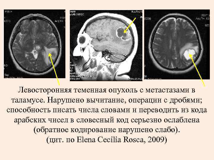  Левосторонняя теменная опухоль с метастазами в таламусе. Нарушено вычитание, операции с дробями;