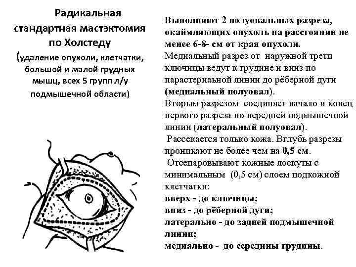   Радикальная       Выполняют 2 полуовальных разреза, стандартная