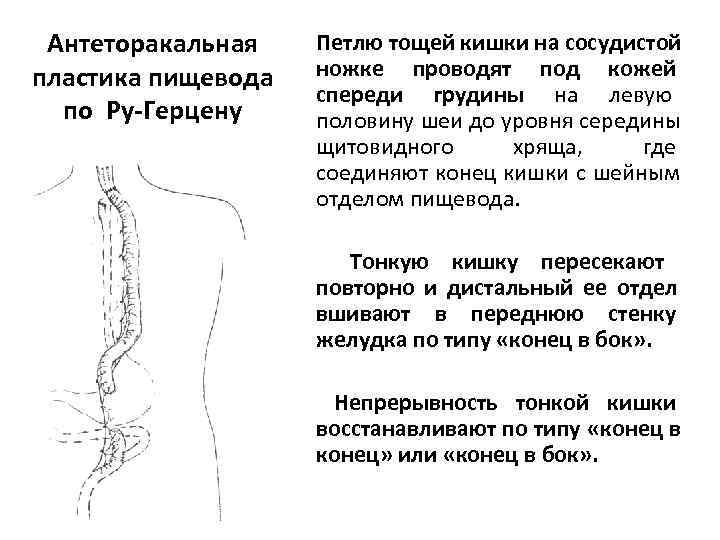 Принципы пластики пищевода