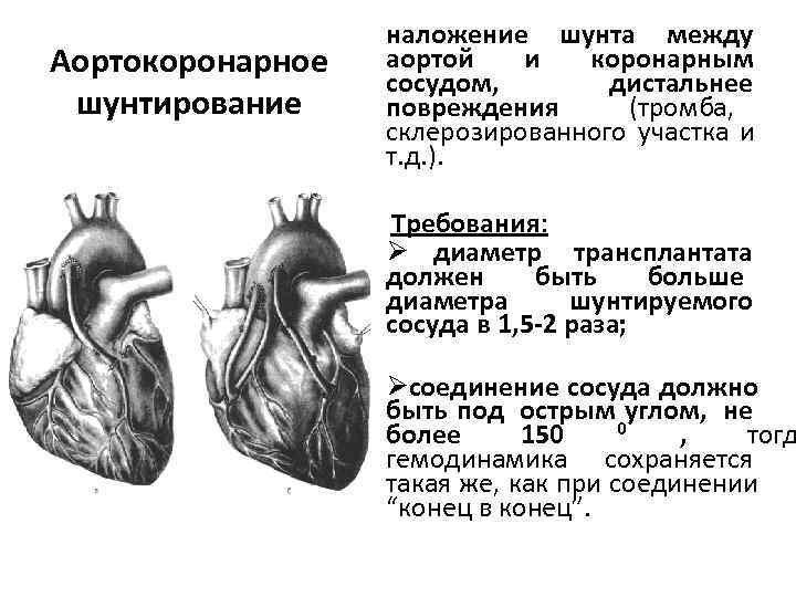 Аортокоронарное шунтирование презентация