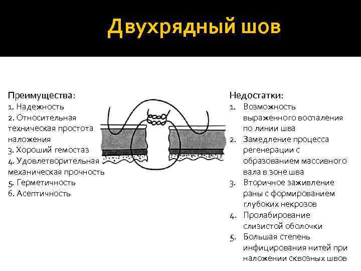      Двухрядный шов Преимущества:     Недостатки: 1.