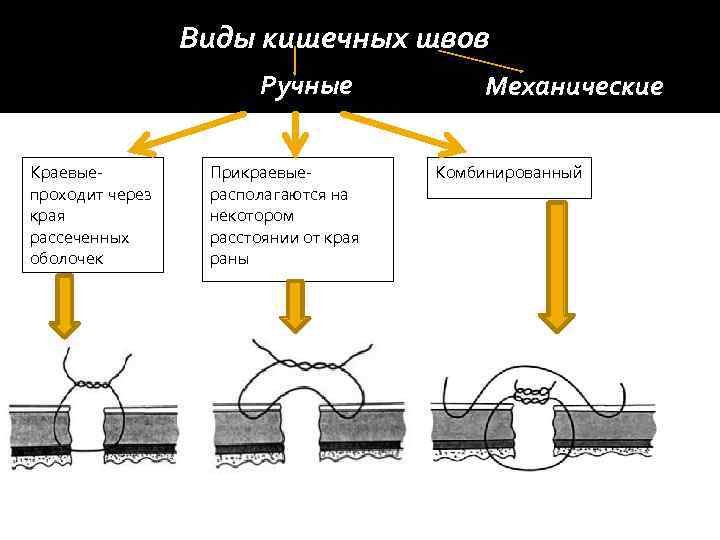    Виды кишечных швов     Ручные   Механические