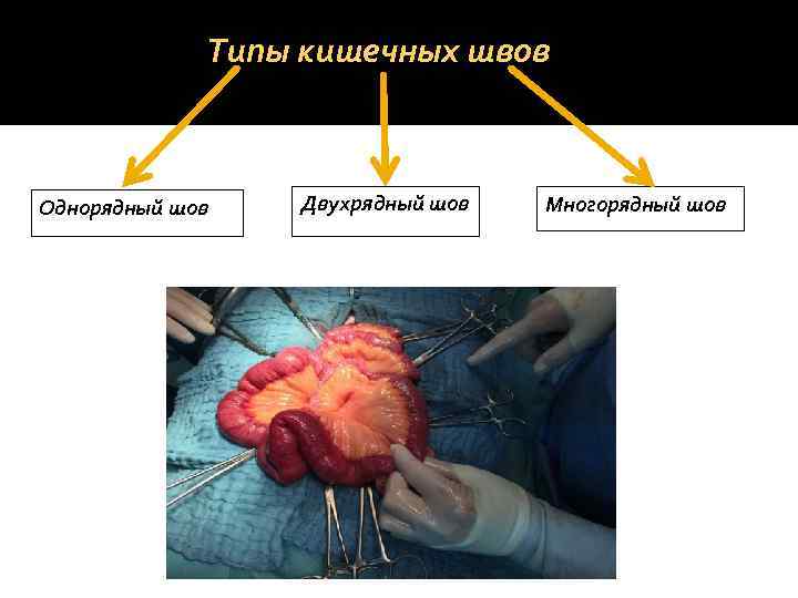    Типы кишечных швов  Однорядный шов  Двухрядный шов  Многорядный