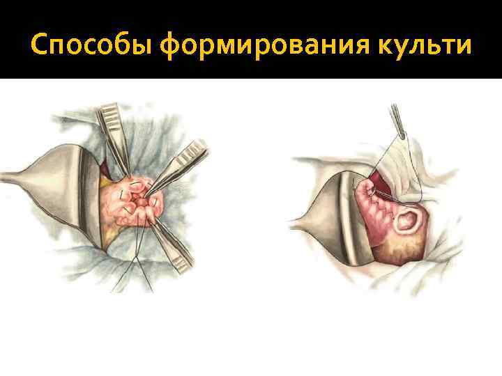 Способы формирования культи 