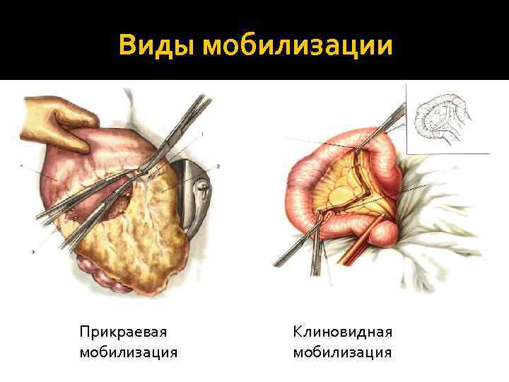   Виды мобилизации Прикраевая  Клиновидная мобилизация 