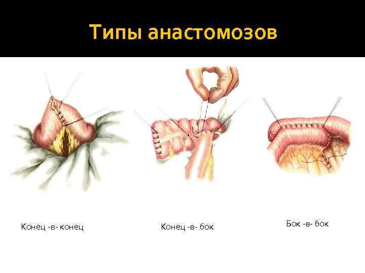    Типы анастомозов Конец -в- конец   Конец -в- бок 