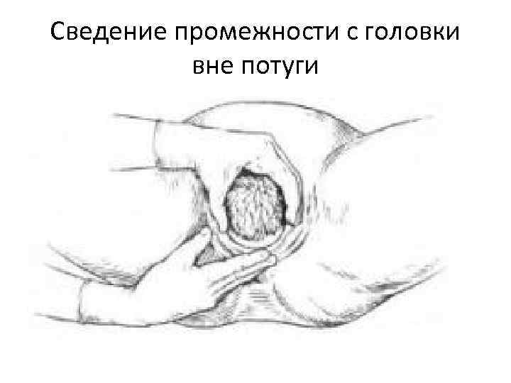 Сведение промежности с головки  вне потуги 