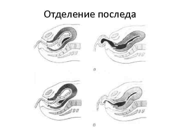 Отделение последа 