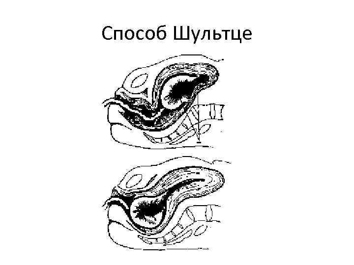 Способ Шультце 