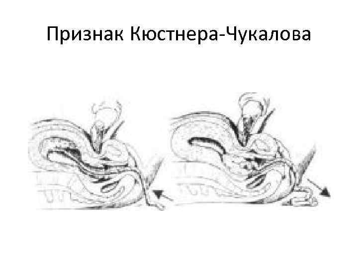 Признак Кюстнера-Чукалова 