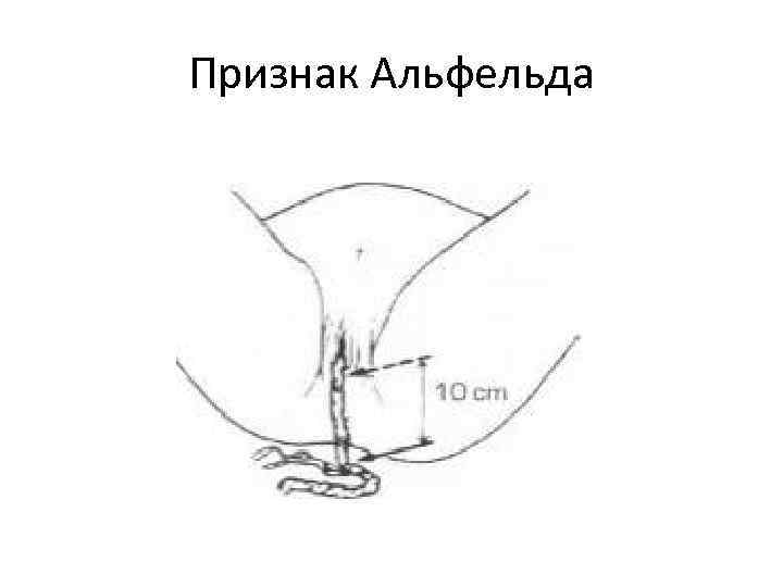 Признак Альфельда 