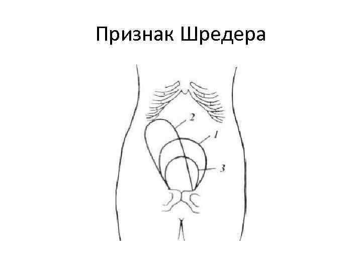 Признак Шредера 