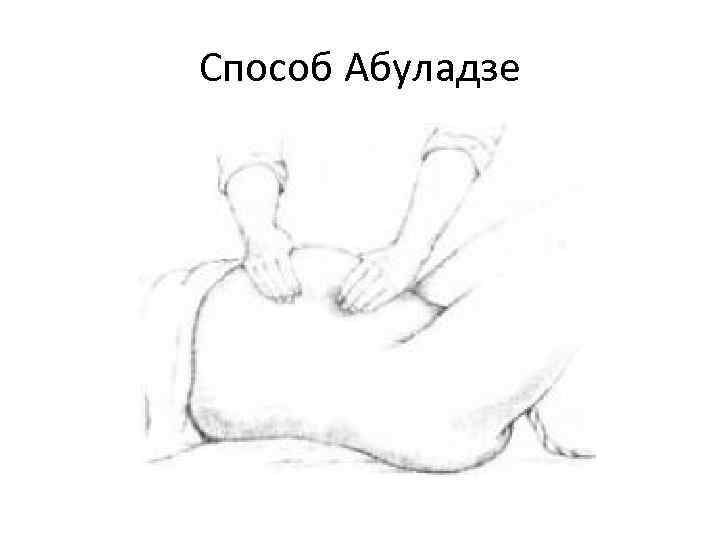 Способ Абуладзе 
