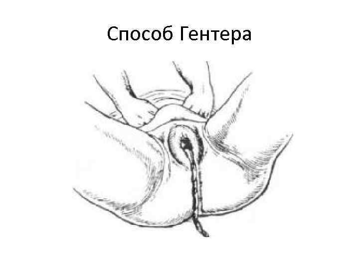 Способ Гентера 