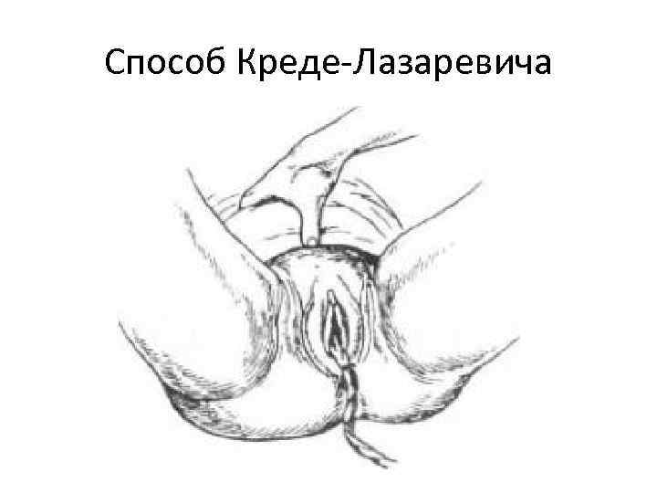 Способ Креде-Лазаревича 