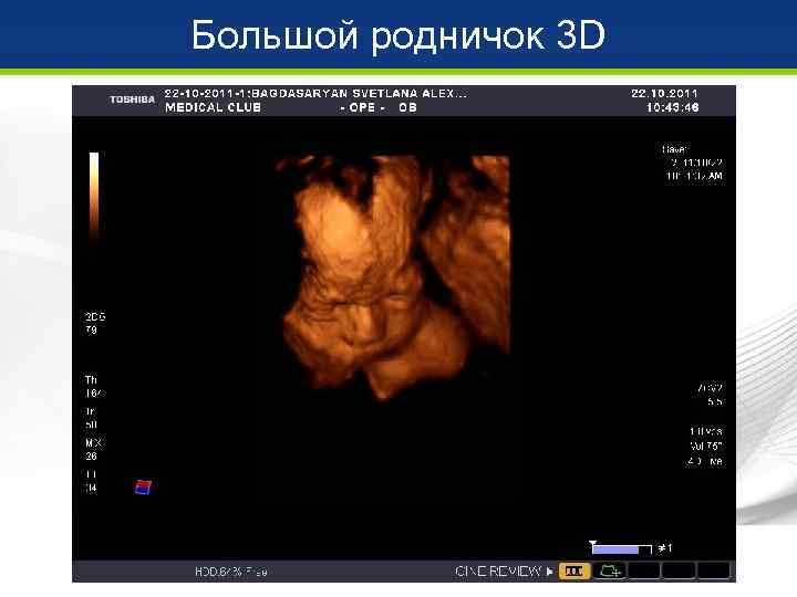 Большой родничок 3 D 