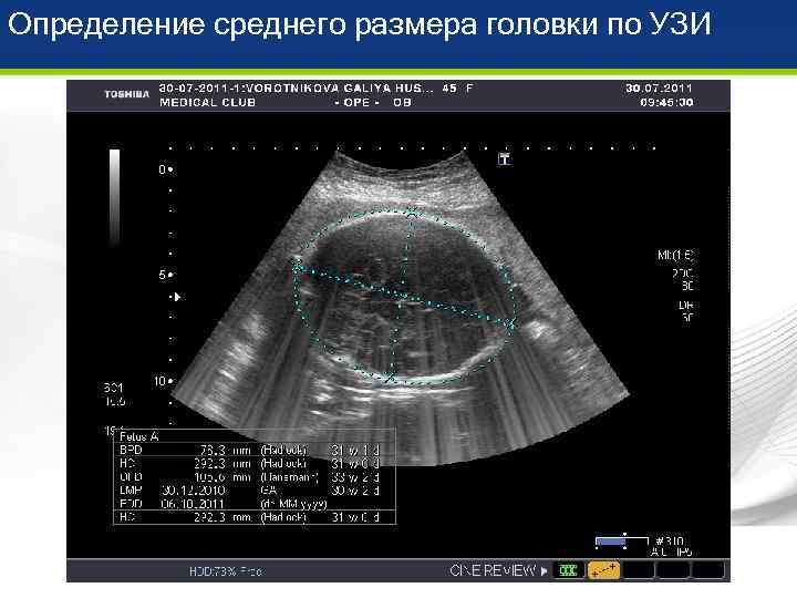 Определение среднего размера головки по УЗИ 