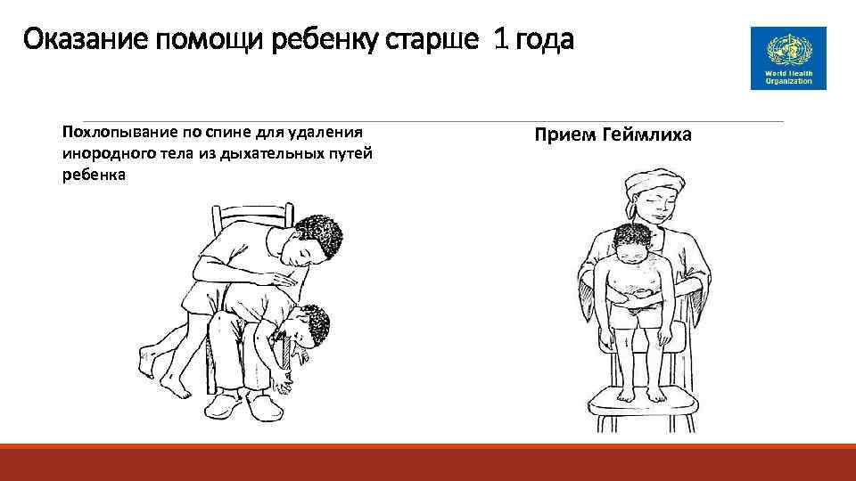 Оказание помощи ребенку старше 1 года  Похлопывание по спине для удаления Прием Геймлиха