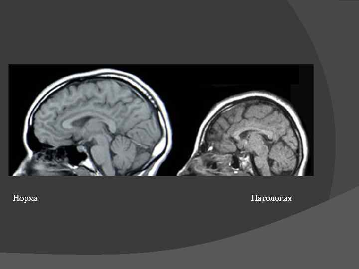 Норма        Патология 