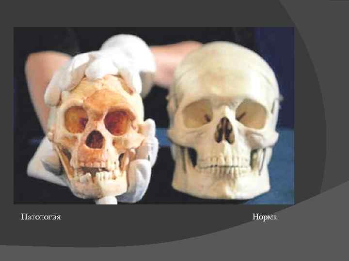   Патология        Норма 