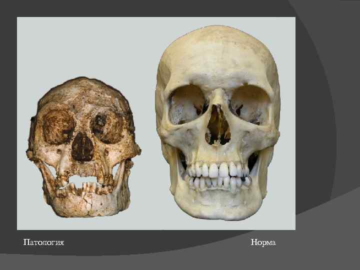  Патология       Норма 