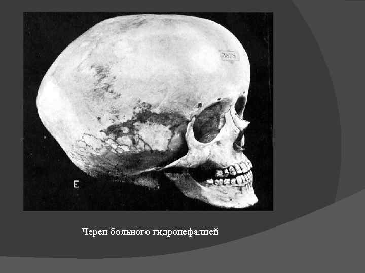 Череп больного гидроцефалией 
