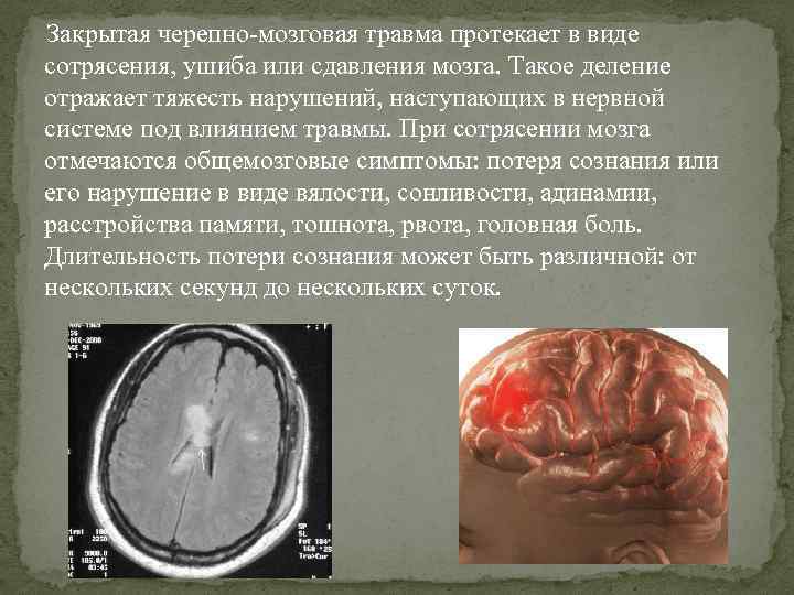Закрытая черепно-мозговая травма протекает в виде сотрясения, ушиба или сдавления мозга. Такое деление отражает Закрытая черепно-мозговая травма протекает в виде сотрясения, ушиба или сдавления мозга. Такое деление отражает