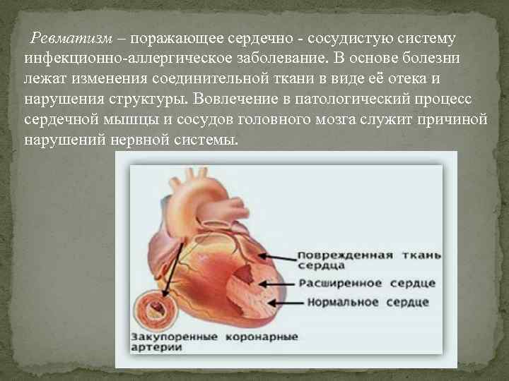 Ревматизм – поражающее сердечно - сосудистую систему инфекционно-аллергическое заболевание. В основе болезни лежат Ревматизм – поражающее сердечно - сосудистую систему инфекционно-аллергическое заболевание. В основе болезни лежат