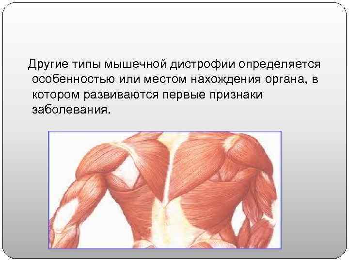  Другие типы мышечной дистрофии определяется  особенностью или местом нахождения органа, в 