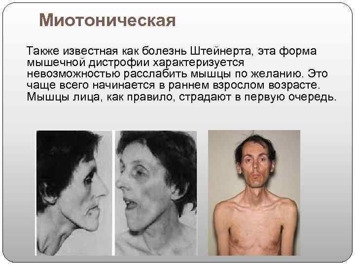   Миотоническая  Также известная как болезнь Штейнерта, эта форма мышечной дистрофии характеризуется