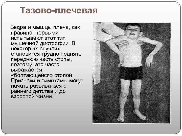  Тазово-плечевая  Бедра и мышцы плеча, как правило, первыми испытывают этот тип мышечной