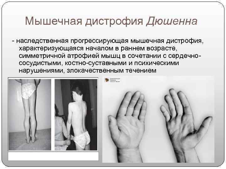   Мышечная дистрофия Дюшенна - наследственная прогрессирующая мышечная дистрофия, характеризующаяся началом в раннем