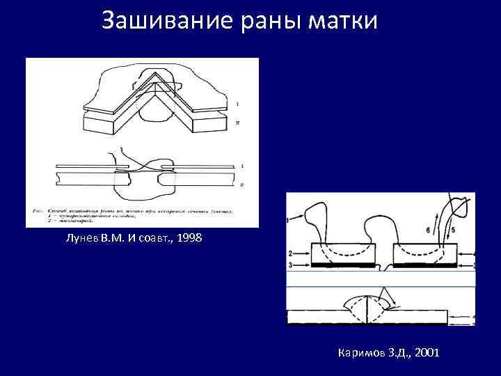 Зашивание раны матки Лунев В. М. И соавт. , 1998 Каримов З. Д. ,