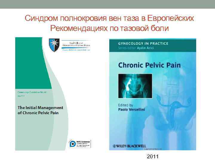 Синдром полнокровия вен таза в Европейских Рекомендациях по тазовой боли    