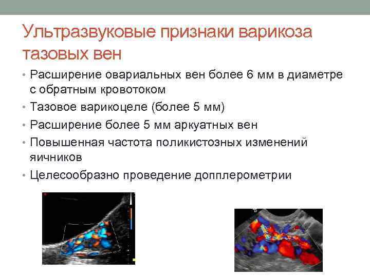 Ультразвуковые признаки варикоза тазовых вен • Расширение овариальных вен более 6 мм в диаметре