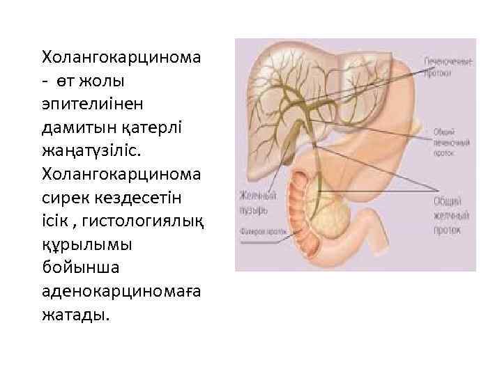 Холангокарцинома - өт жолы эпителиінен дамитын қатерлі жаңатүзіліс.  Холангокарцинома сирек кездесетін ісік ,