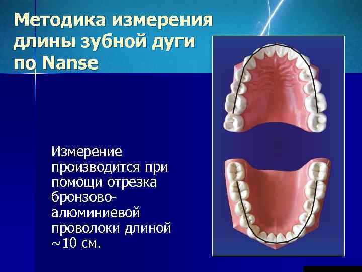 Методика измерения длины зубной дуги по Nanse  Измерение  производится при  помощи